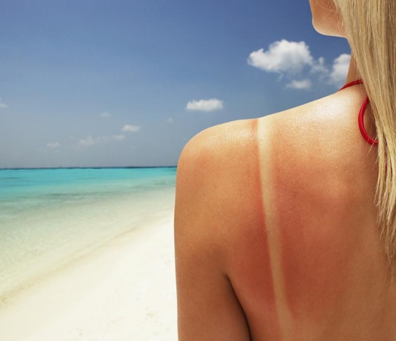 Photo of a sunburn